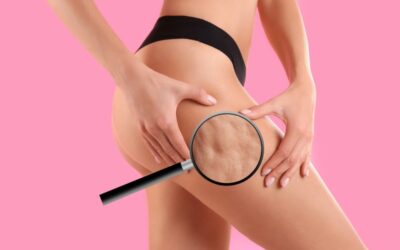 Jak wygląda cellulit? Przewodnik po rodzajach i przyczynach „pomarańczowej skórki”